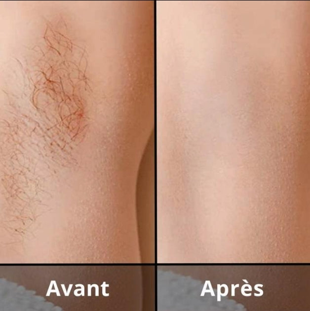 ÉPILATEUR IPL